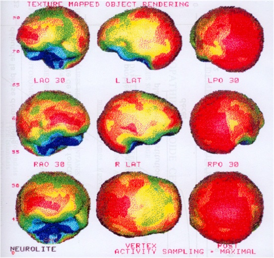 démence sénile vasculaire